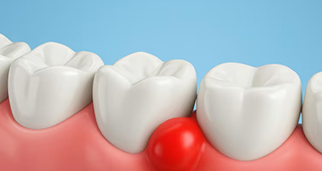 歯ぐきが腫れる・血が出る