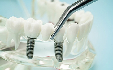 しっかり噛める歯を取り戻したい