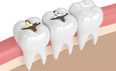 詰め物・被せ物が外れた