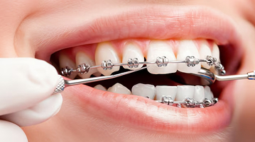 歯並びを整えたい