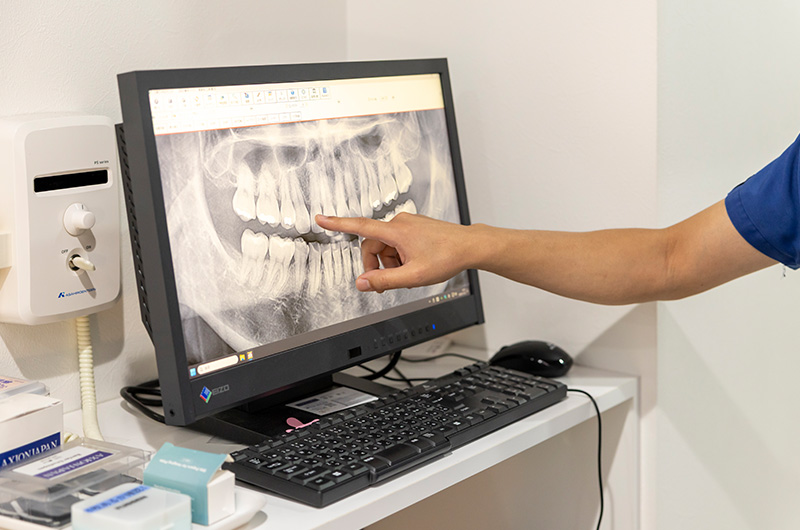 インプラント治療の特徴と選ばれる理由