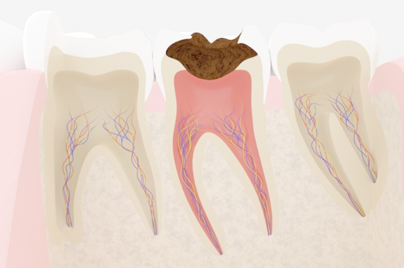 歯への影響（むし歯・欠け・ひび割れ）