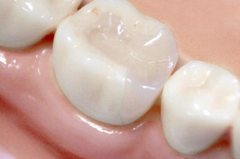 歯ぐき・歯周組織への影響