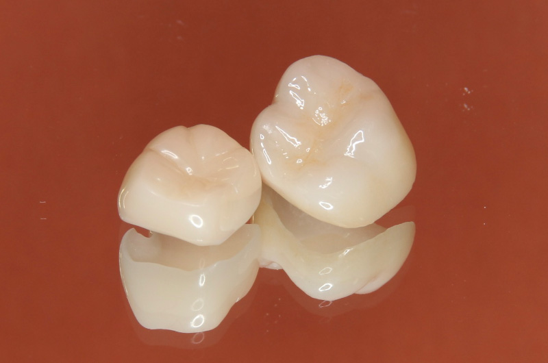 詰め物・被せ物について