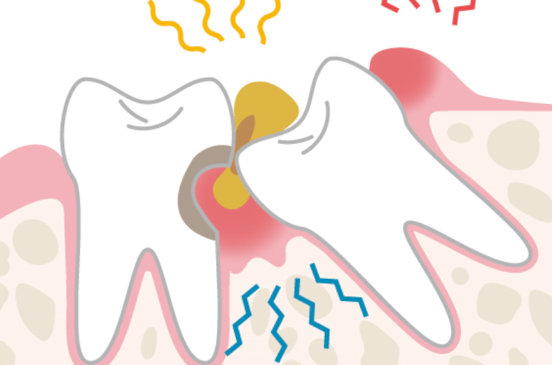 親知らずについて