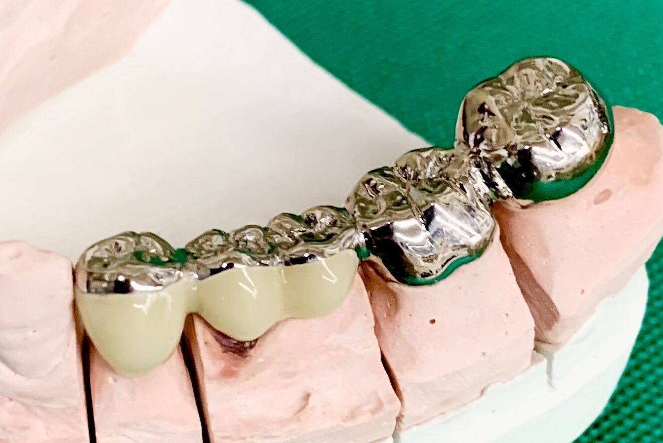 ブリッジの種類とそれぞれの特徴